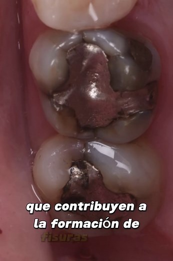 Mi opinión sobre la amalgama #dental #smile #amalgama #reynosa #mcallen