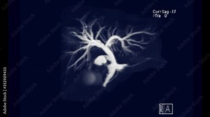 MRCP or Magnetic resonance cholangiopancreatography 3D MIP turn around on the screen showing visualize the biliary and pancreatic ducts .
