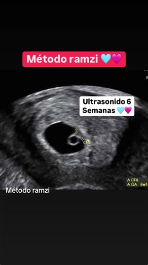 Método Ramzi: Ultrasonido de Embarazo y Revelación de Género