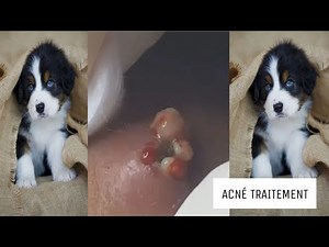 Extraction point noir, acné, kyste en profondeur #23