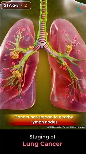 Staging of Lung Cancer ↪ 3D Medical Animation #Shorts #LungCancer #Lung #Cancer #shorts