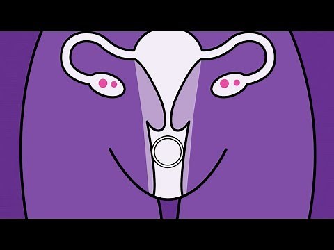Brook Contraception - Vaginal Ring Animation