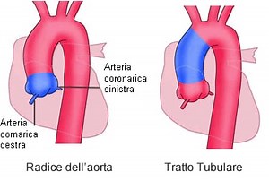 Aorta