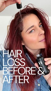 I thought my hairline was gone for good. 💔 But I gave @oneskin.co OS-01 Hair Serum a shot and here’s what happened. 😳 ✨ Here’s why it’s not like anything else I’ve tried: 🔹 Water-based = NO greasy buildup 🔹 Lightweight = Dries invisibly 🔹 Doesn’t leave hair crunchy or gross 🔹 Targets the root causes of hair loss (not just a cosmetic fix) 🔹 Powered by a peptide that extends the lifespan of scalp skin cells 🔹 Clinically tested with results you can see 🔹 Great for hair loss and more import