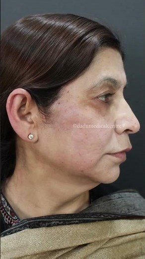 Thread Lift journey | Dadu Medical Centre