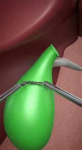 Do You Need Gallbladder Surgery? Here’s What Happens