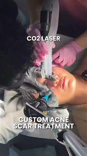 Custom Acne Scar Treatment