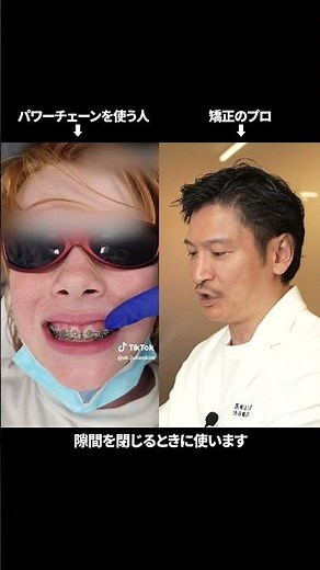 パワーチェーンって知ってますか？ #歯列矯正#矯正歯科#shorts