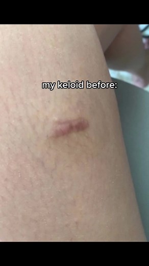 The Ultimate Guide to Keloid Scar Removal