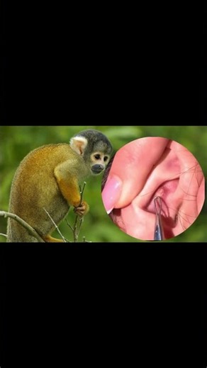 Removing Acne Blackheads on skin, cleaning everywhere