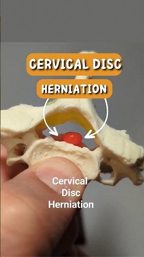 Cervical Disc Herniation: Rupture of Cervical Disc Model