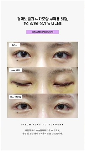 결막노출과 ㄷ자모양 부작용 해결, 1년 8개월 장기 유지 사례 #시선성형외과 #skincare