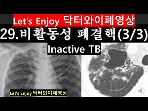29#폐결핵영상#폐결핵#비활동성폐결핵#stabletuberculosis#폐결핵사진#肺結核#흉부X선#흉부Xray #DrYchestradiology#닥터와이폐영상#inactiveTB