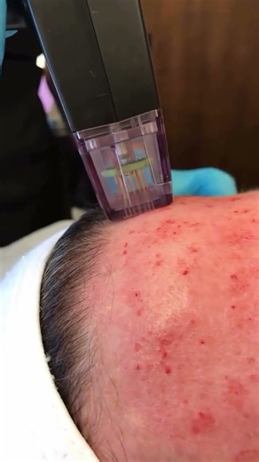 This Treatment TIGHTENS YOUR SKIN and You Should TRY IT! #morpheus8 #skincare
