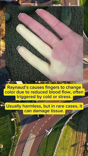 Raynaud’s Phenomenon: When Fingers Turn Blue from Cold & Stress