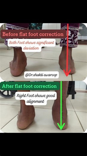 Minimally Invasive Flat Foot Correction #flatfoot #FlatFootCorrection #footsurgery