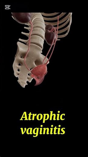 Atrophic vaginitis#gynecology#1millionviews#3danimation#viralvideo