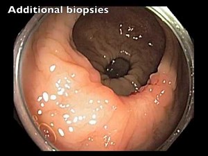 Rectum - EMR Scar • Video • MEDtube.net