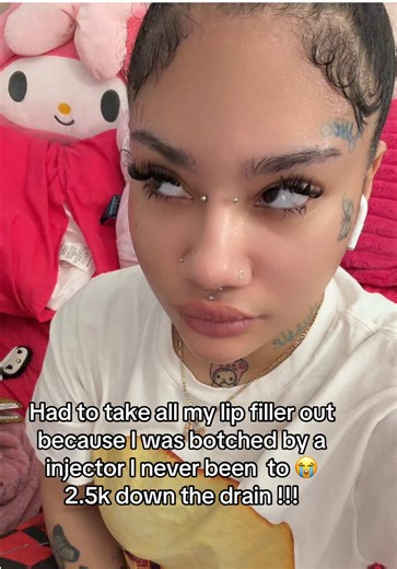 Was such a painful experience taking everything out but I’m glad everything is out and I can redo them in 2 weeks 😭 I learned my lesson #foryou #fyp #viral #fyppppppppppppppppppppppp #lipfiller