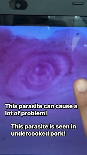 Trichinella spiralis!