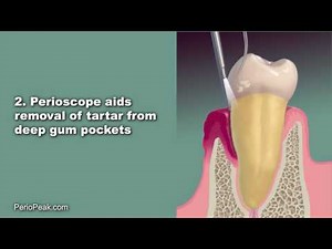 Regenerative Periodontal Endoscopy - Perioscopy with Emdogain - Gum Disease Treatment