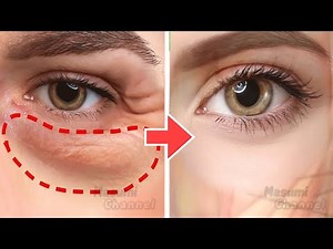 Anti-Aging Face Exercises For Eye Bags, Dark Circles Under Eyes, Eye Wrinkles | No Surgery!