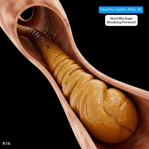 Realistic Colon Animation of Compacted Stool Cracking and Moving With Peristalsis #shorts