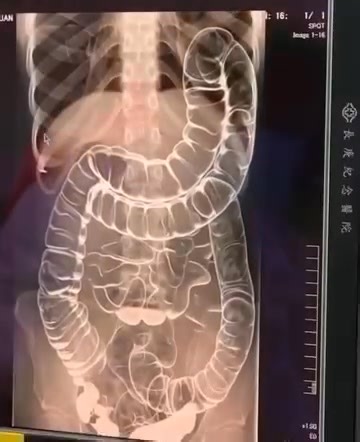 This is an X-ray image of a young woman who suffered from chronic constipation. One day, after experiencing continuous symptoms for over two weeks, she went for a medical check-up. https://ludi.feji.io/blog/everything-you-need-to-know-about-chronic-constipation-a-hidden-threat-to-your-digestive-health-kqx | Mariann Laurena