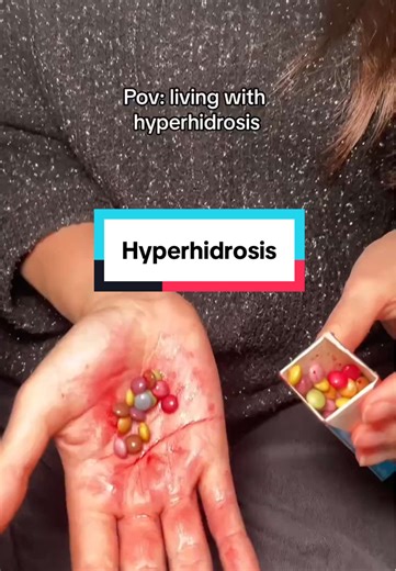 Have you ever heard of Botox injections for excessive sweating?! It's a real treatment! #hyperhidrosis #sweat #antiperspirant #lifehack
