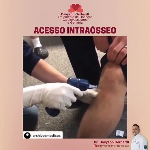 ACESSO INTRAÓSSEO