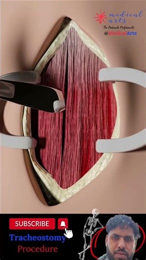 Tracheostomy procedure 3D animation #college #hospital