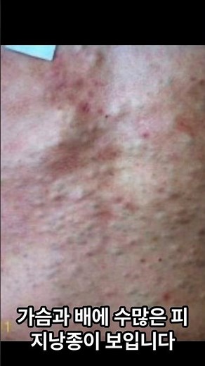 다발성 피지낭종 수술 후 경과