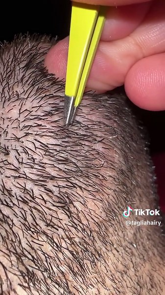 Pili Multigemini Hair Plucking | Compound Hair Removal