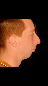 Brow Ridge Analysis with FaceIQ Labs