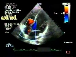 Combined Shunt: Septal Aneurysms, Atrial Septal Defect (ASD), Ventricular Septal Defect (VSD) • Video • MEDtube.net