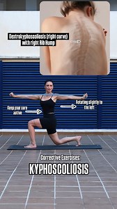 In dextrokyphoscoliosis, the spine curves to the right (dextro-), and the rib hump appears on the right side due to spinal rotation. When performing a corrective exercise with a resistance band, the spine should be rotated toward the opposite side of the hump – in this case, to the left – while maintaining good alignment and control. Why? Rotating to the left helps counteract the excessive right rotation of the vertebrae, gently guiding the spine toward a more neutral position and reducing the p