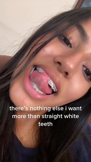 Straightening My Smile: The Journey to Perfect Teeth