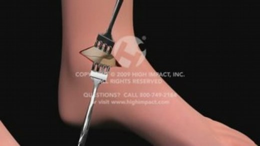 Open Reduction Internal Fixation