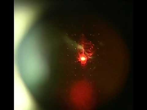 Eye Floater Laser Vitreolysis Patient of Scott Geller MD
