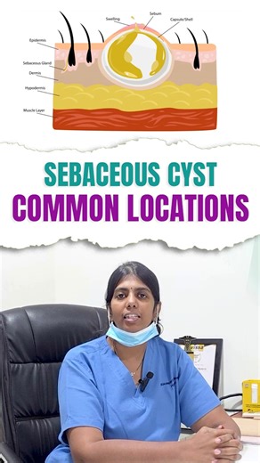 A Lump Under Skin? It Could Be a Sebaceous Cyst #doctor #shorts #drjahnavikoneru