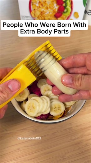 Extra Body Parts: Fascinating Cases Explained