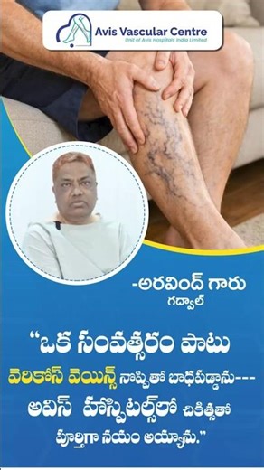 Lecturer Finds Relief After a Year of Varicose Veins | Avis Hospitals