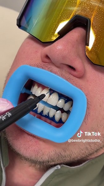 Pearly White Teeth Whitening Transformation