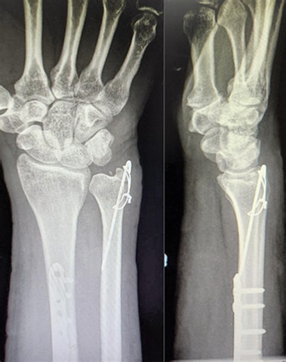 Arthroscopic Examination of the Triangular Fibrocartilage Complex in Galeazzi Injuries: Revisiting a Complex Injury
