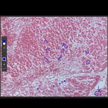 (병리학) 응고괴사, 심장