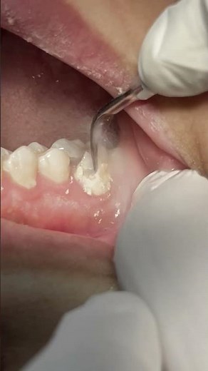 Scaling and cleaning teeth tartar & calculus #satisfying