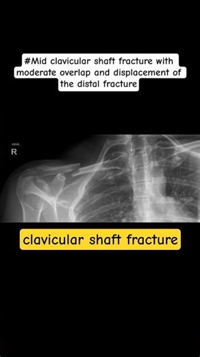 #clavicular shaft fracture, buety bone fracture #shortvideo