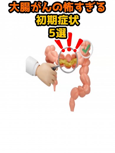 大腸がんの初期症状と生活習慣の影響