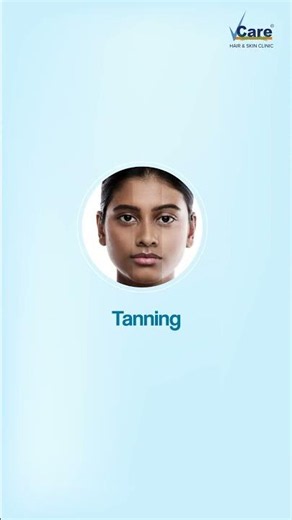 Summer sun leaving behind tanning, patchy pigmentation & dull skin?