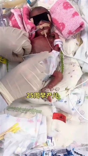 🇨🇳 25周早产儿通常被称为“极早产儿”，体重往往不足一斤。 🇬🇧 A 25-week premature baby is typically called an “extremely preterm baby,” often weighing less than one pound. 🇨🇳 这些小生命在出生时身体各器官发育极不成熟，皮肤薄如蝉翼。 🇬🇧 These tiny lives are born with extremely immature organs and skin as thin as a cicada's wing. 🇨🇳 现代医学的进步让这些“掌心宝宝”有了生存的可能，但他们仍需在保温箱中经历数月的生命挑战。 🇬🇧 Advances in modern medicine have made survival possible for these “palm-sized babies,” though they still face months of life challenges in incubators. 🇨🇳 每一个成功活下来